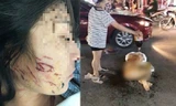 Nạn nhân bị đổ mắm và muối ớt lên người, khuôn mặt cũng bị nhiều vết rách