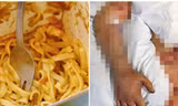 Nam sinh ăn mì gà để tủ lạnh qua đêm của bạn cùng phòng, phải phẫu thuật bỏ chân tay