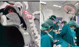 Đang câu cá thì bị cá nhảy luôn vào họng, một người Thái Lan phải phẫu thuật khẩn cấp