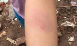 Học sinh cho gia đình biết những vết thâm tím