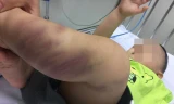 Cháu bé gần 1 tuổi nhập viện với nhiều thương tích trên cơ thể.
