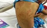 Những lằn roi ngang dọc trên người bé gái 8 tuổi. Ảnh: Hải Hiếu