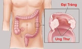 Ung thư trực tràng nguy hiểm thế nào?