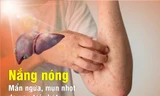 Nắng nóng – Mẩn ngứa, mụn nhọt do gan tái phát
