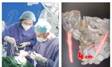 Phẫu thuật thành công xương mỏm trâm dài 4cm, nữ bệnh nhân 60 tuổi thoát khỏi đau đớn 