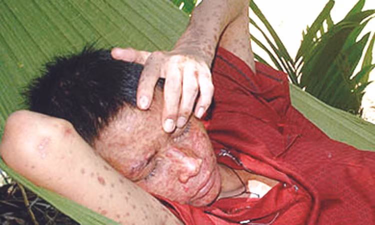 Người mắc 
