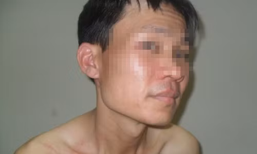 Mới chuyển về nhà mới được gần 2 tuần, anh Huy đã 2 lần bị kiến ba khoang đốt