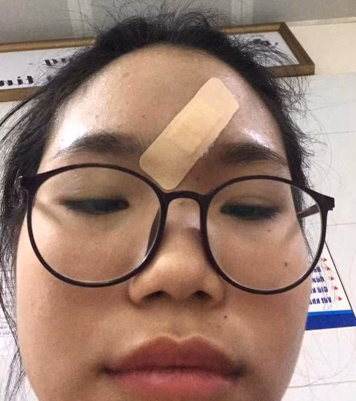 Gần đây, em Lộc Khánh Huyền thường xuyên bị chảy máu ở trán mà không có vết thương hở. Ảnh: Duy Chiến Gần đây, em Lộc Khánh Huyền thường xuyên bị chảy máu ở trán mà không có vết thương hở. Ảnh: Duy Chiến