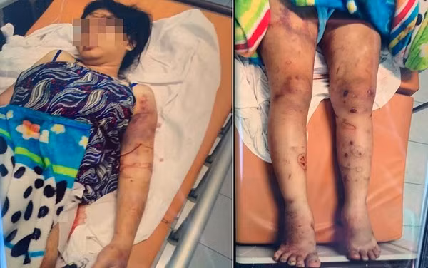 Vụ cô gái 18 tuổi bị tra tấn đến sẩy thai: Bắt tạm giam một đối tượng ảnh 2 Vụ cô gái 18 tuổi bị tra tấn đến sẩy thai: Bắt tạm giam một đối tượng ảnh 2
