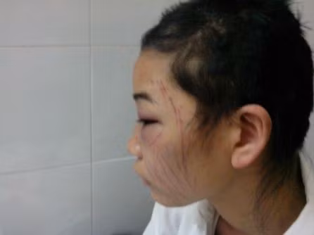 Chị Hường điều trị tại BV Quân y 103 với nhằng nhịt vết thương trên mặt. Ảnh: Pháp luật và xã hội. Chị Hường điều trị tại BV Quân y 103 với nhằng nhịt vết thương trên mặt. Ảnh: Pháp luật và xã hội