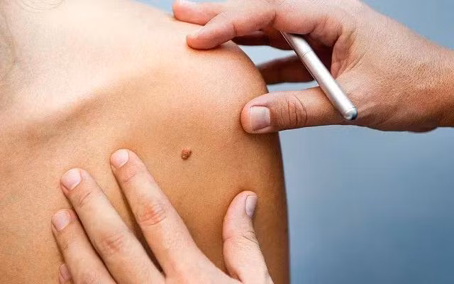 Ung thư da là một trong các ung thư thường gặp và khá dễ chẩn đoán. Ung thư da (không kể ung thư hắc tố) là các ung thư xuất phát từ biểu mô da che phủ mặt ngoài cơ thể, gồm nhiều lớp tế bào. Ảnh minh họa: Internet