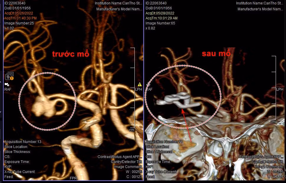 Túi phình mạch máu não của bệnh nhân đã bị vỡ khi huyết áp tăng cao (hình bên trái) Túi phình mạch máu não của bệnh nhân đã bị vỡ khi huyết áp tăng cao (hình bên trái)