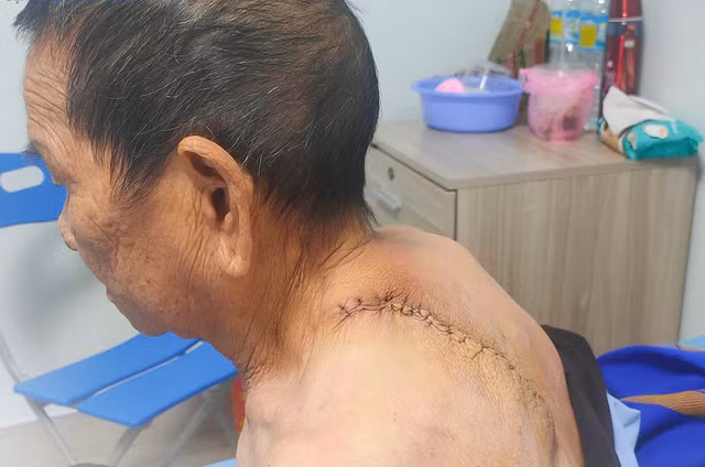 Các bác sĩ phẫu thuật cắt bỏ thành công khối u. Ảnh: Bệnh viện Bình Định
