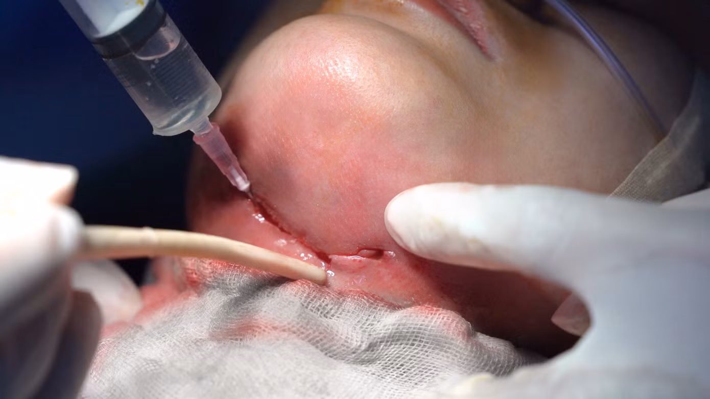 Sau phẫu thuật, bệnh nhân đã được đặt máy hút (VAC) và tiếp tục theo dõi, điều trị