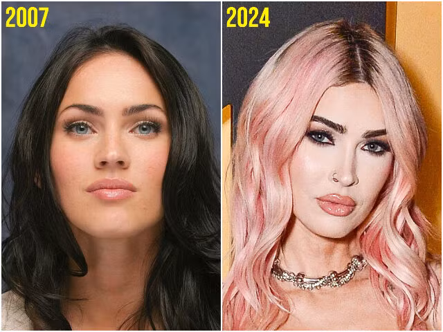 Một số bác sĩ thẩm mỹ cho rằng cô nàng đã tiêm botox, filler, nâng chân mài và sửa mũi.