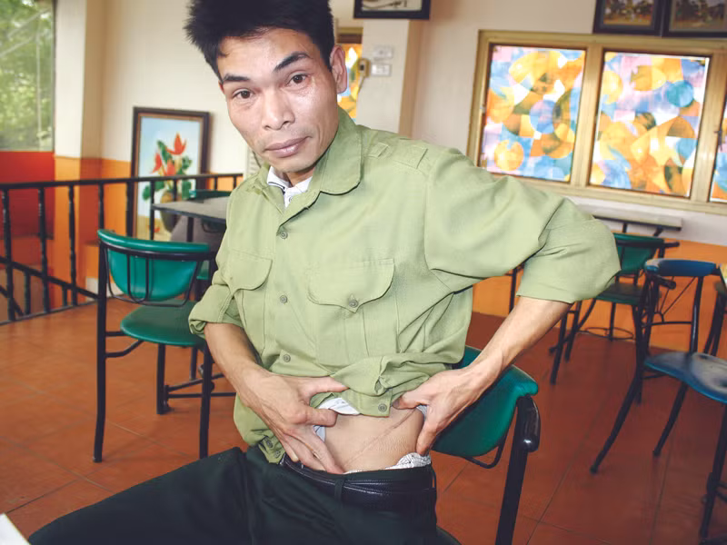 Anh Vũ Quốc Tuấn và vết mổ để hiến thận 