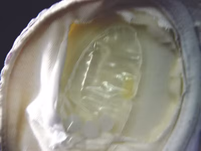 Mẫu dung dịch chứa các hạt lạ, gây rát ngứa