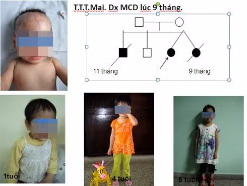 Một bé bị rối loạn chuyển hóa bẩm sinh đã được cứu sống. Đến nay bé phát triển hoàn toàn bình thường. Trước đó, một người chị song sinh và người anh trai của bé không được chẩn đoán đúng bệnh đã mất. Ảnh: Bệnh viện cung cấp