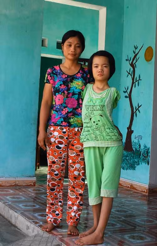 Nguôi đi nỗi đau sinh con ra không có cả hai cánh tay, chị Tình hiện rõ nỗi buồn khi nhìn đứa con gái càng lớn càng bị vẹo cột sống và hai chân không đều nhau
