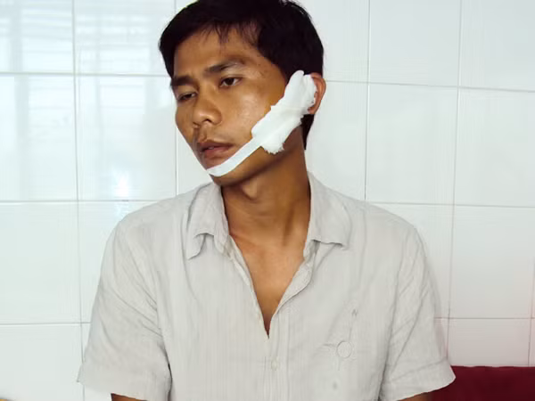 Anh Bình bị chém thương tích nặng trên mặt 