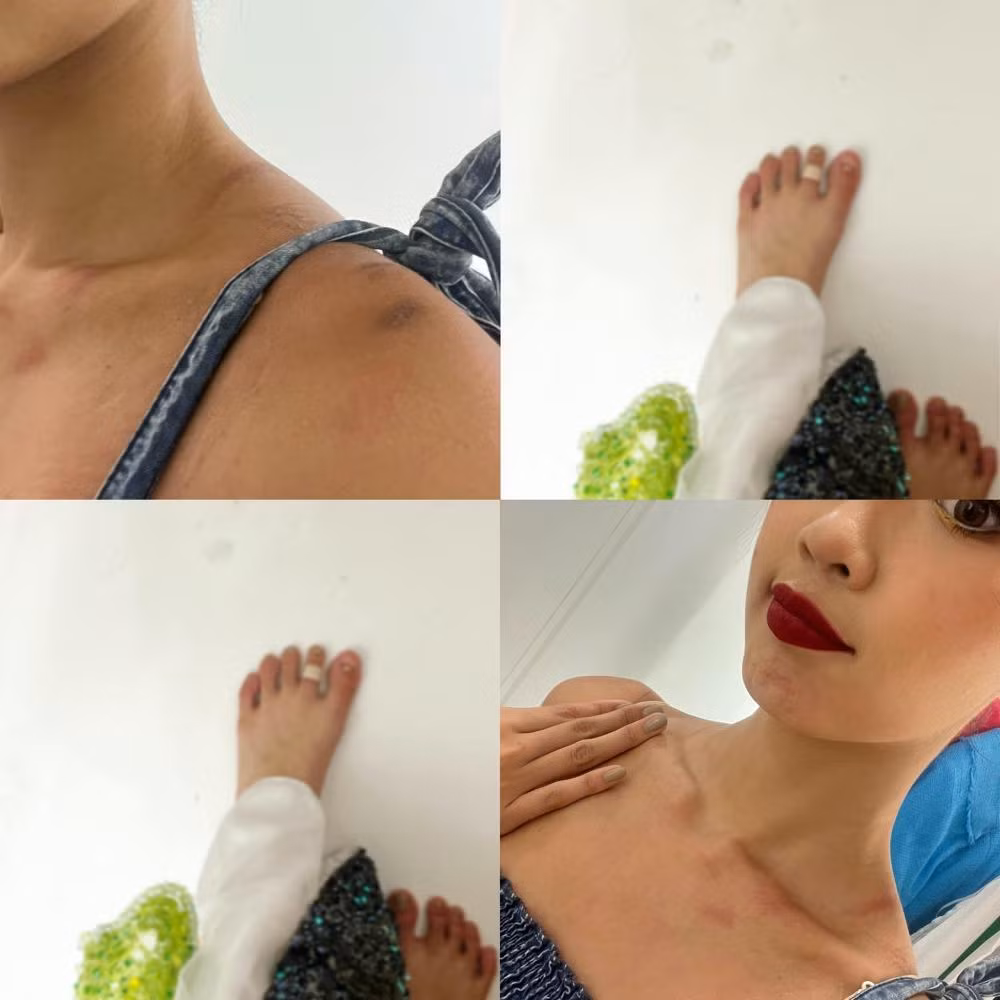 Á hậu Bảo Ngọc bị chấn thương nhẹ ở cổ, vai và chân vì bộ trang phục quá nặng