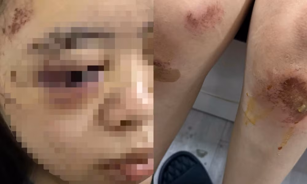 Hai đầu gối của L. bị trầy xước khá nặng sau khi bị bắt quỳ xin lỗi, khuôn mặt sưng vù. (Ảnh: Nhân vật cung cấp cho báo chí)