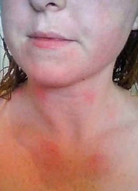 Nốt phát ban xuất hiện khi Katie tiếp xúc với nước