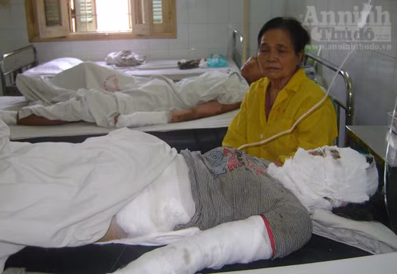 Chị Nguyễn Thị Ngân nằm tại khoa Bỏng- Bệnh viện Xanh-Pôn. Ảnh An ninh Thủ đô