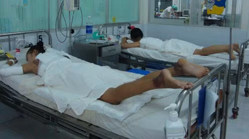 Thủy Tiên (trái) tại khoa phỏng - chỉnh hình (Bệnh viện Nhi Đồng 1) với bắp tay và lưng bị cháy đen