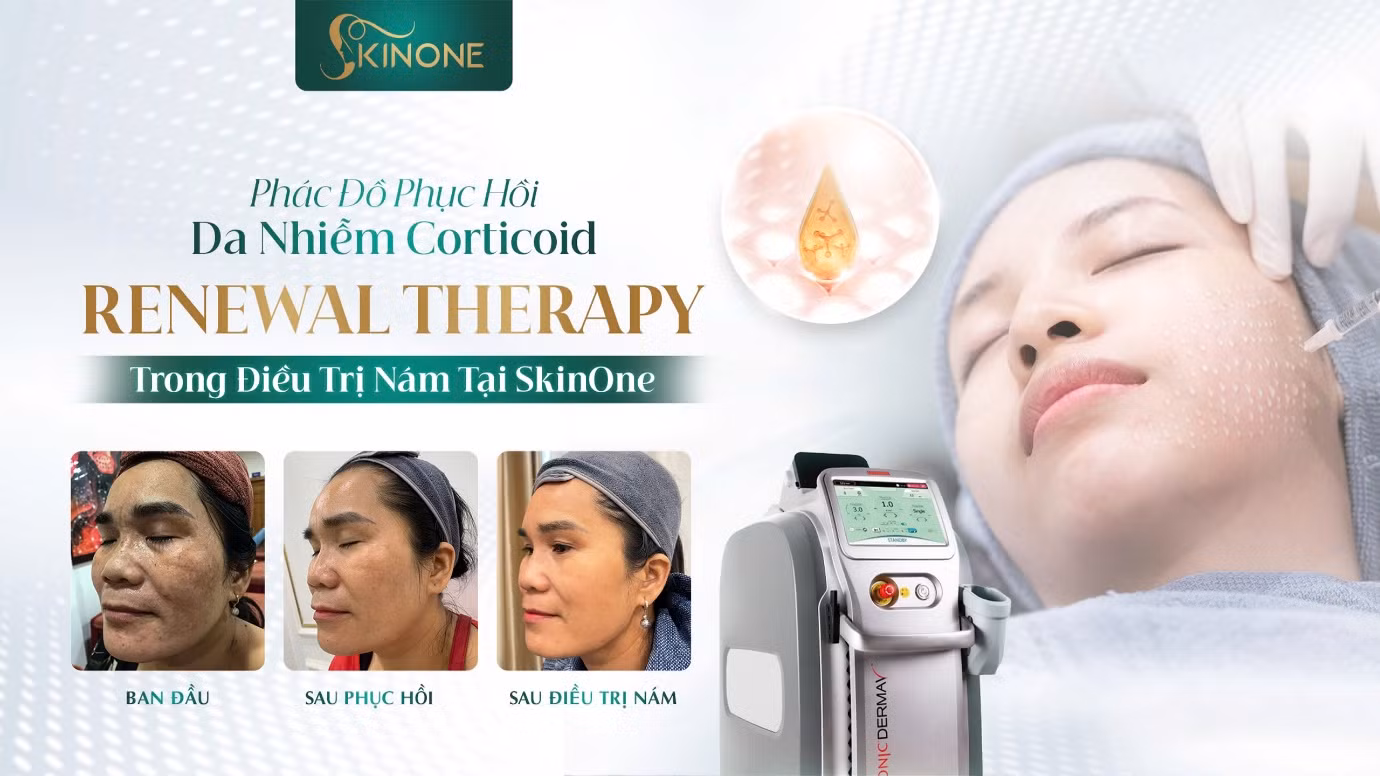 Phác đồ phục hồi da mỏng yếu trước khi điều trị nám Phác đồ phục hồi da mỏng yếu trước khi điều trị nám