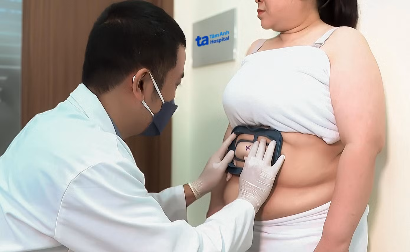 Bác sĩ Tùng đo, đánh dấu vùng mỡ trước khi dùng công nghệ cao hủy mỡ. Ảnh: BVĐK Tâm Anh