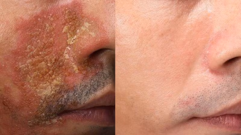Hiệu quả điều trị vảy nến sau 20 ngày liệu trình Mezoplex tại DRH Clinic Hiệu quả điều trị vảy nến sau 20 ngày liệu trình Mezoplex tại DRH Clinic