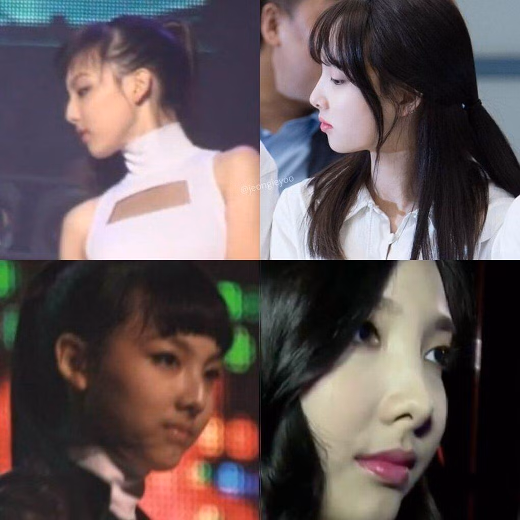 Nayeon (TWICE) bị nghi ngờ chỉnh hàm và mũi