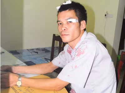 Lái xe buýt của Xí nghiệp xe buýt Thăng Long Phạm Hoàng Anh với thương tích trên đầu và mắt. Ảnh: Tuấn Nguyễn