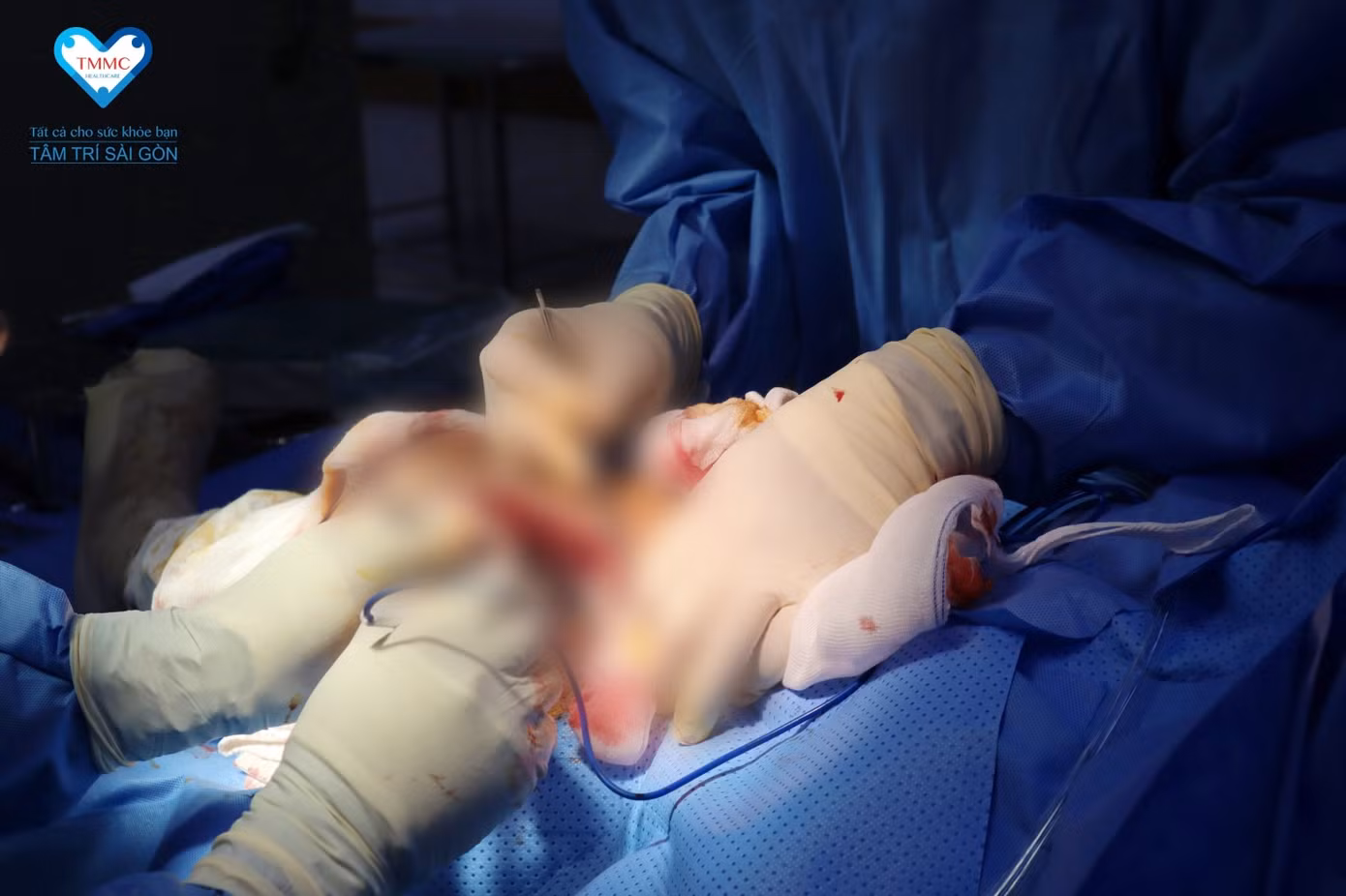 Bác sĩ BVĐK Tâm Trí Sài Gòn tiến hành phẫu thuật cấp cứu Bác sĩ BVĐK Tâm Trí Sài Gòn tiến hành phẫu thuật cấp cứu