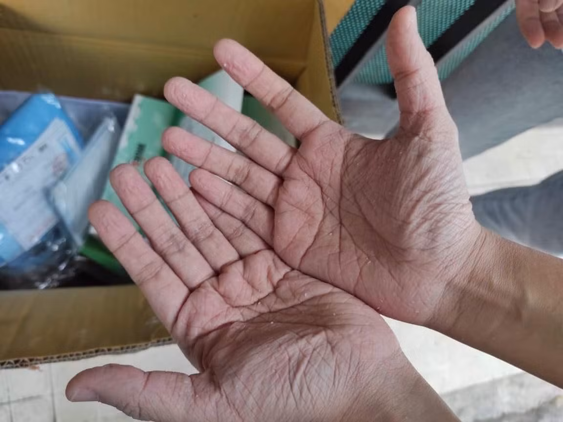Bàn tay nhăn nhúm, trắng bệch lại sau 12 tiếng làm việc trong bộ đồ bảo hộ