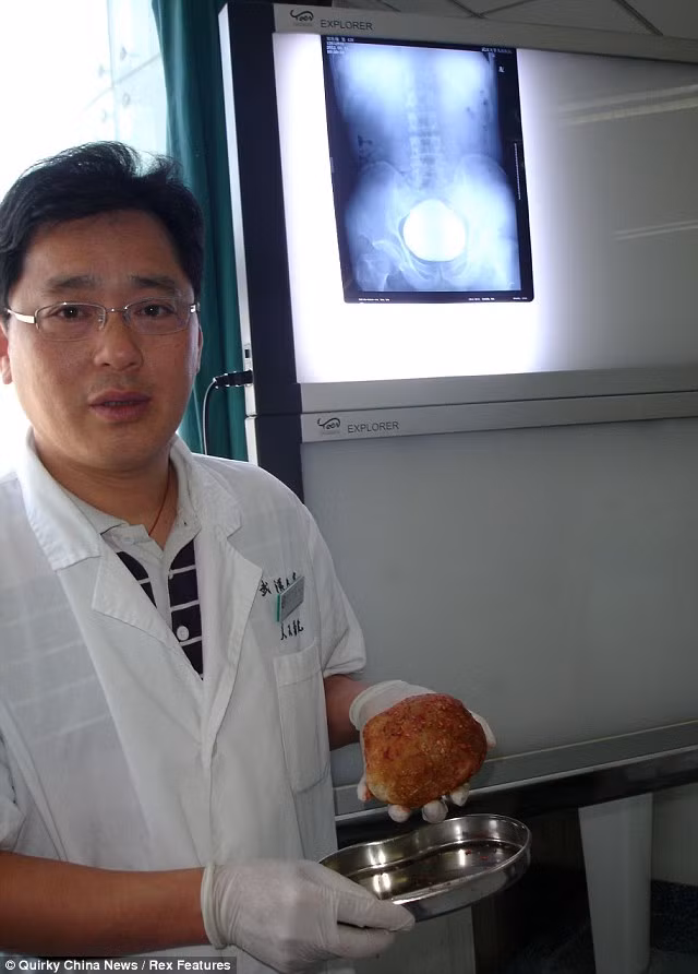 Bác sĩ Ngô Thiên Bằng cầm cục sỏi