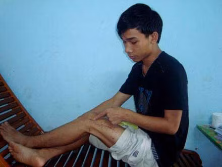 Vết thương ở chân em Hiếu ngày càng đau nhức, khiến việc sinh hoạt vô cùng khó khăn