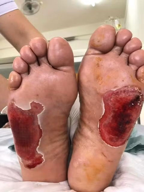 Bỏ đá vào lò vi sóng để chữa tiểu đường, cụ ông bỏng nặng ảnh 1