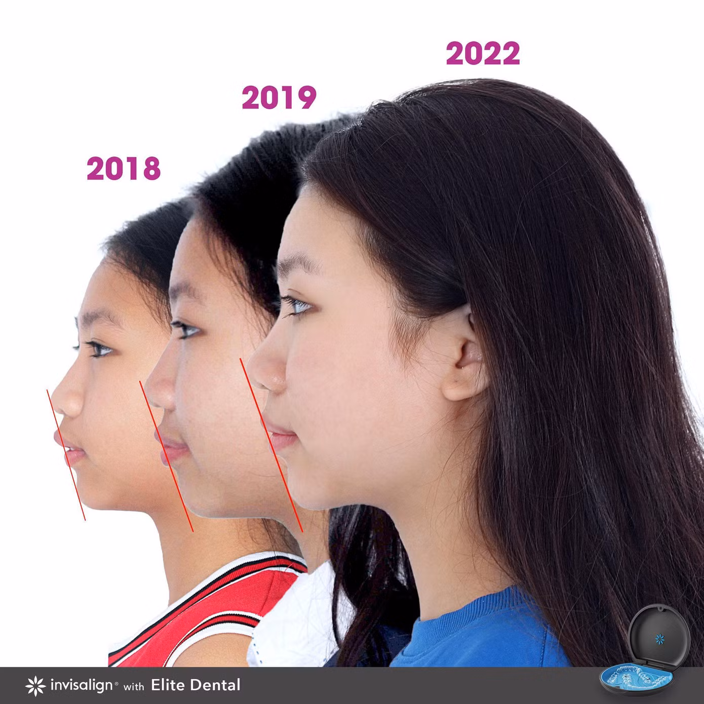 Sau gần 3 năm, L.V đã kết thúc hành trình niềng răng với kết quả mỹ mãn, khuôn miệng xinh xắn, góc nghiêng thanh tú. Sau gần 3 năm, L.V đã kết thúc hành trình niềng răng với kết quả mỹ mãn, khuôn miệng xinh xắn, góc nghiêng thanh tú.
