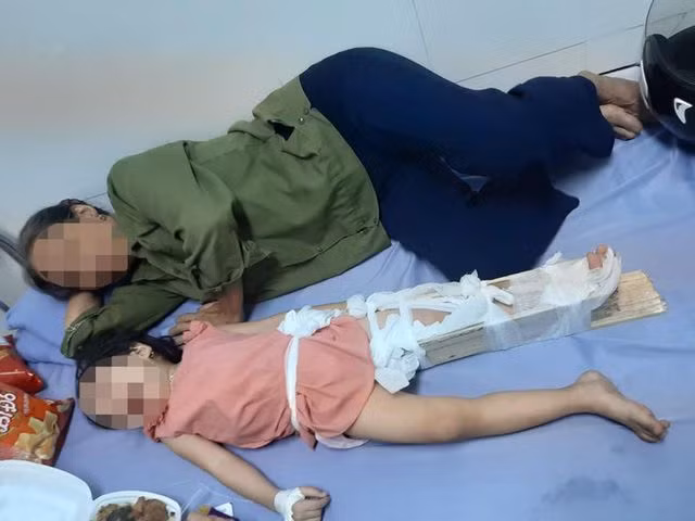 Hình ảnh cháu M.A đang nẹp sơ cứu.