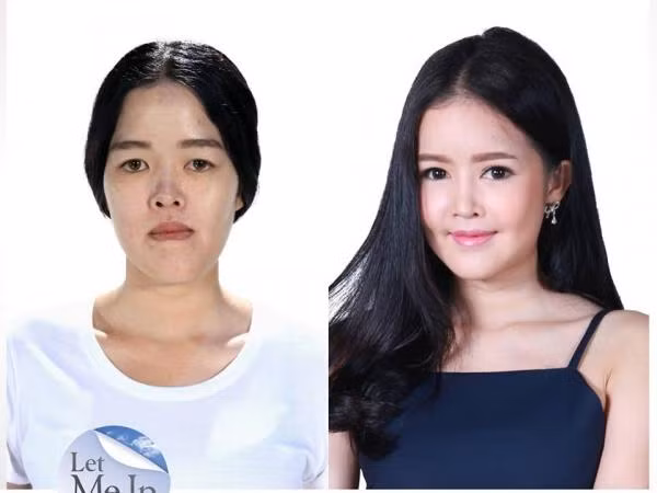 Phẫu thuật thẩm mỹ đã thay đổi số phận một người như thế nào? ảnh 12 Phẫu thuật thẩm mỹ đã thay đổi số phận một người như thế nào? ảnh 12