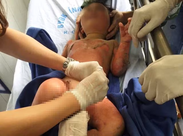 Vụ việc khiến 4 cháu bé bị bỏng, 1 cháu bỏng nhẹ đã được sơ cứu và gia đình đến đón về nhà.