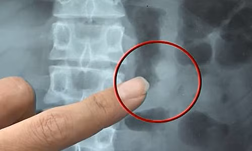 Ảnh chụp X-quang cho thấy chiếc tai nghe nằm trong dạ dày bệnh nhân. (Ảnh: cts.com.tw)