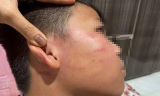 Vụ giáo viên nước ngoài tát học sinh: Gia đình nói bé trai bị thủng màng nhĩ