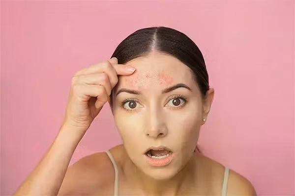 forehead-acne-5412.jpg