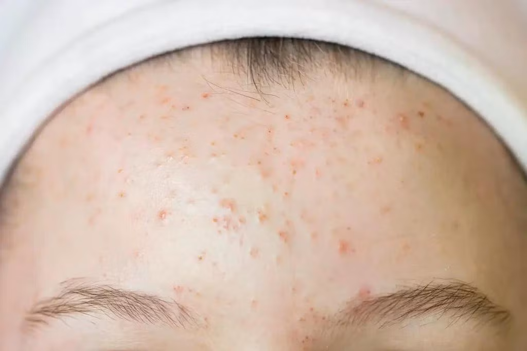 foreahead-acne-1024x682.jpg