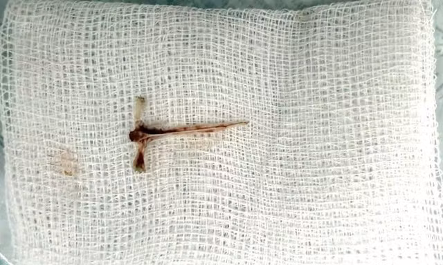 Mảnh xương cá sắc nhọn 'đi lạc' cắm sâu trong khí quản người phụ nữ