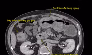 Ca đại phẫu kéo dài hơn 8 giờ giải cứu bệnh nhân mắc ung thư kép