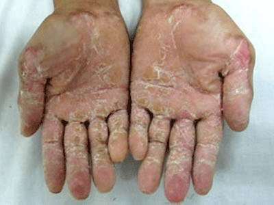 Bàn tay của người bị bệnh